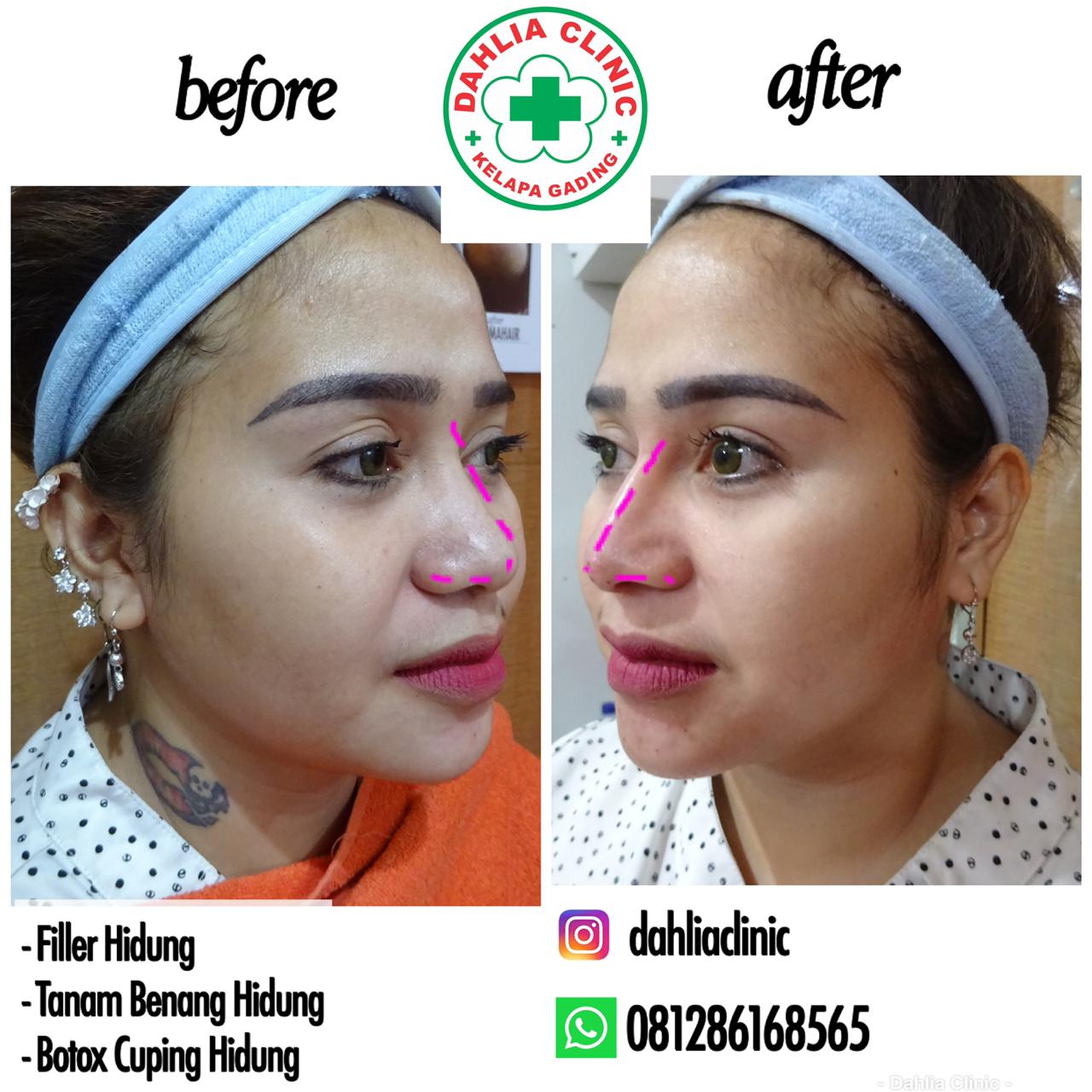 Filler Hidung / Botox Cuping Hidung