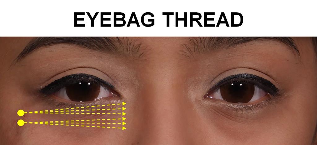 Tanam Benang Kantung Mata