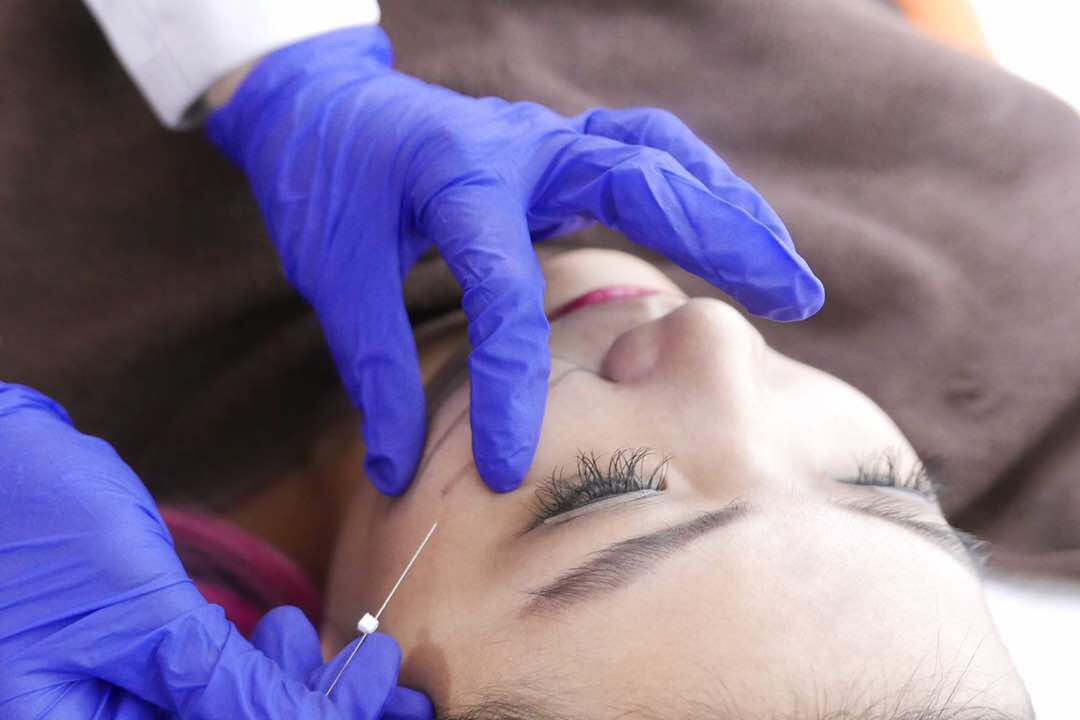 Tanam Benang Wajah - Leher / Threadlift Gold Korea