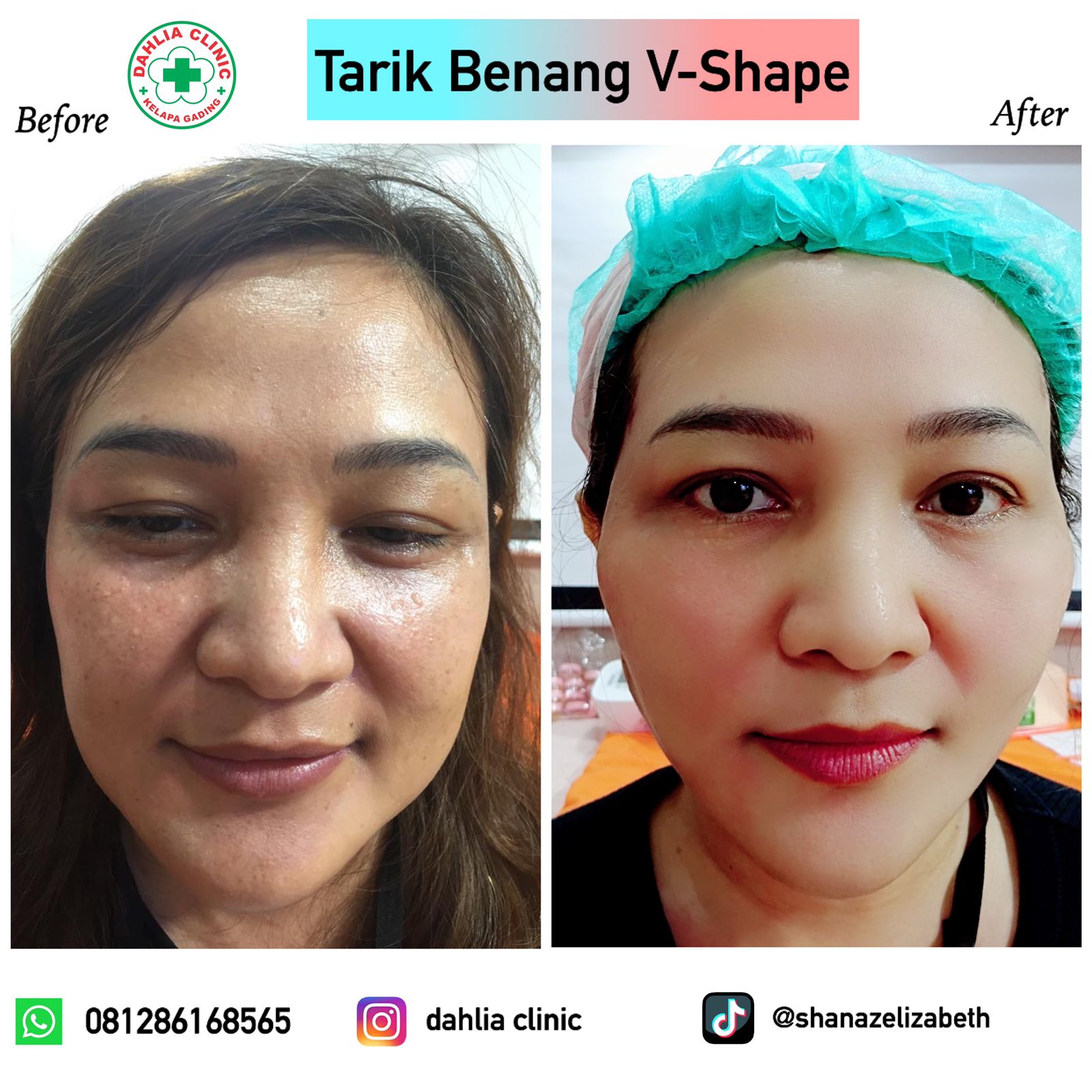 Tarik Benang Wajah / Double Chin Silhouette Double Fix